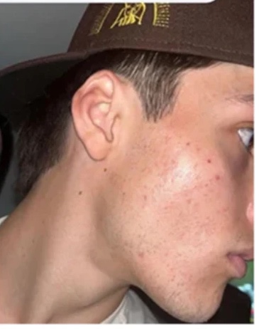 The same customer later, with calmer skin and far fewer blemishes