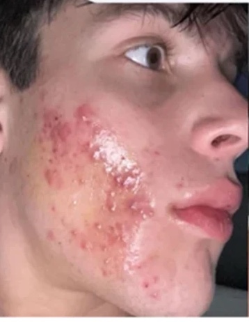 Customer photo before using Norse Organics, showing inflamed acne across the cheek